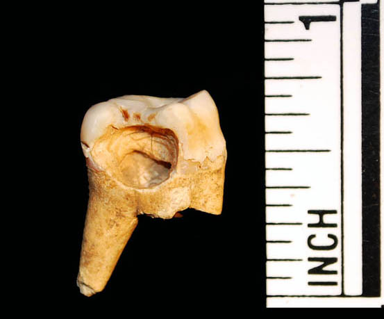 FF Tooth 1