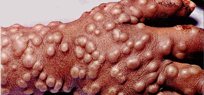 Smallpox pustules on hand